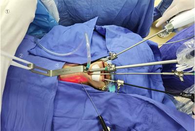 Gasless submental-transoral combined approach endoscopic thyroidectomy: a new surgical technique